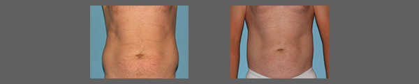 Liposuction Madison 06
