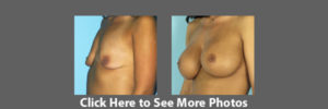 Breast Augmentation Madison WI